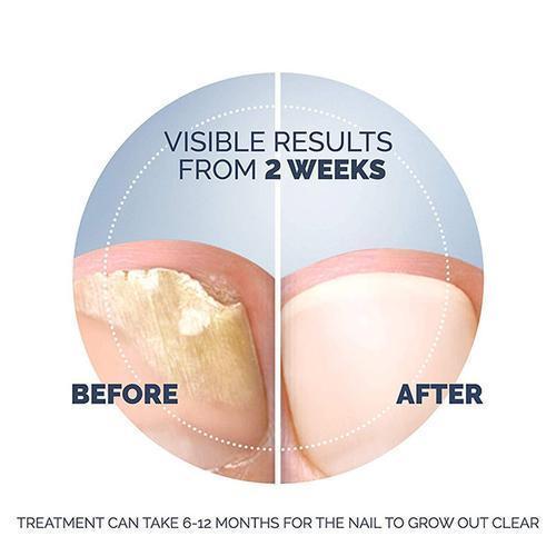 Scholl Aid Fungal Nail Treatment Kit
