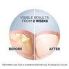 Scholl Aid Fungal Nail Treatment Kit